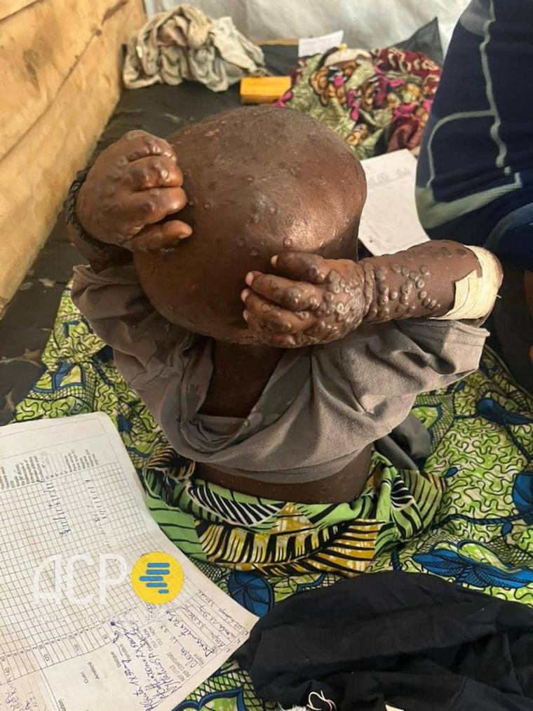 22 cas suspects de Mpox et trois décès signalés dans la zone de santé de Luebo au Kasaï